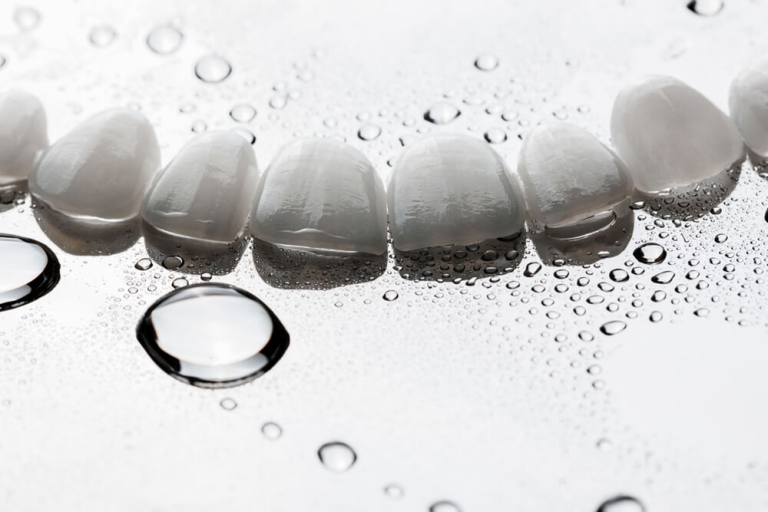 Dental Veneer Costs in Las Vegas: Price Guide