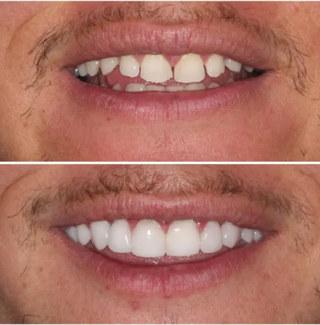 How Much Do Dental Implants Cost in Las Vegas?