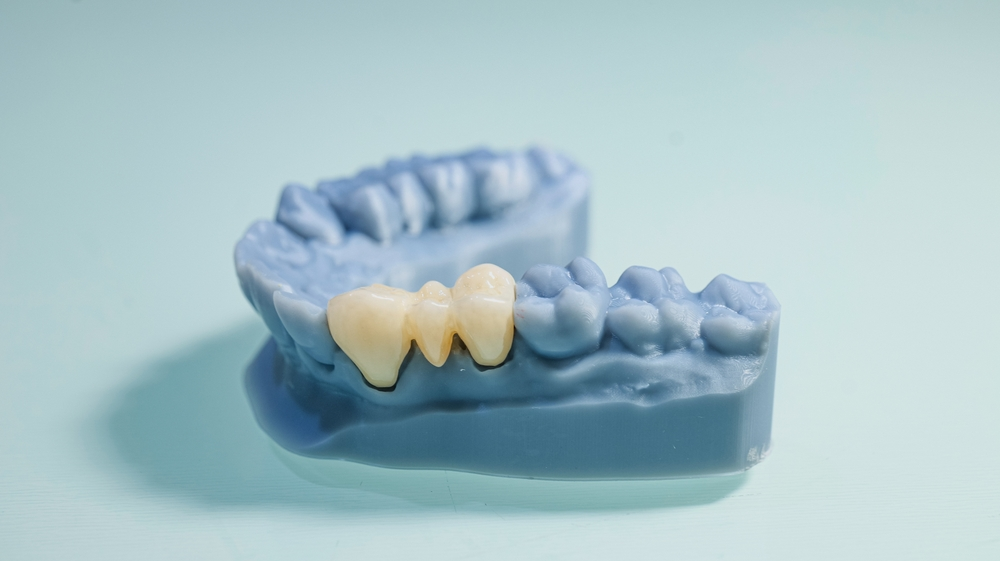 Cown Bridge denture placed on the patient's tooth model