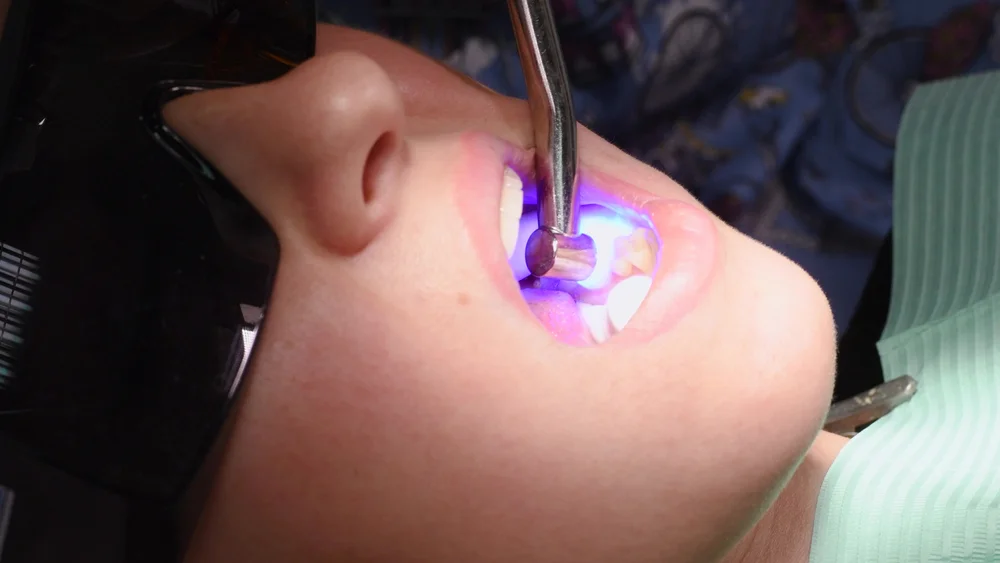 Applying resin based composite filling on tooth and curing it with LED. Young woman at dental clinic.