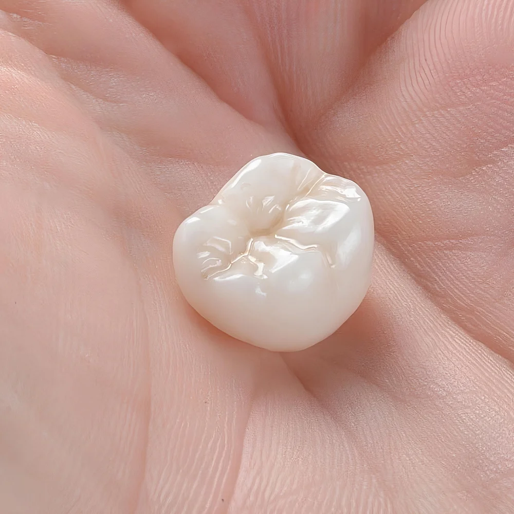 Glass ceramic dental porcelain veneers and crowns used in smile design treatment in dental dentistry.