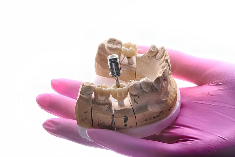Intraosseous,Dental,Implant,Treatment.,Bone,Grafting,For,Tooth,Loss,