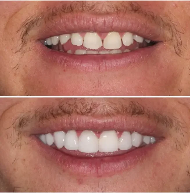 Before-and-after smile showing a front tooth implant.