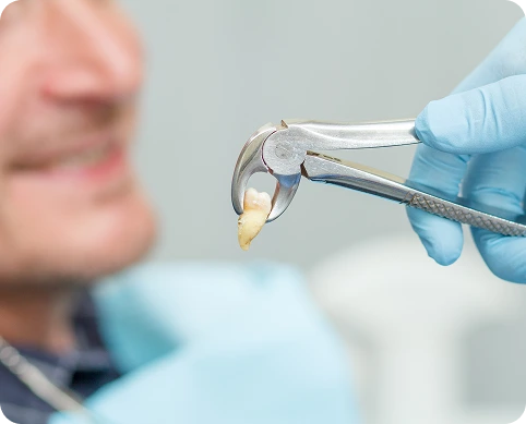 Dentist holding an extracted tooth with dental forceps