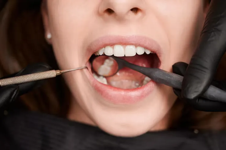 The Dental Crown Procedure: What to Expect Step by Step